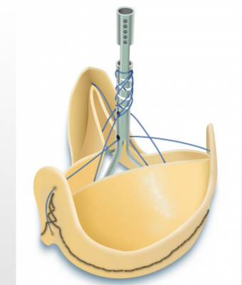 Sorin Group Announces FDA Approval of Solo Smart — the Next